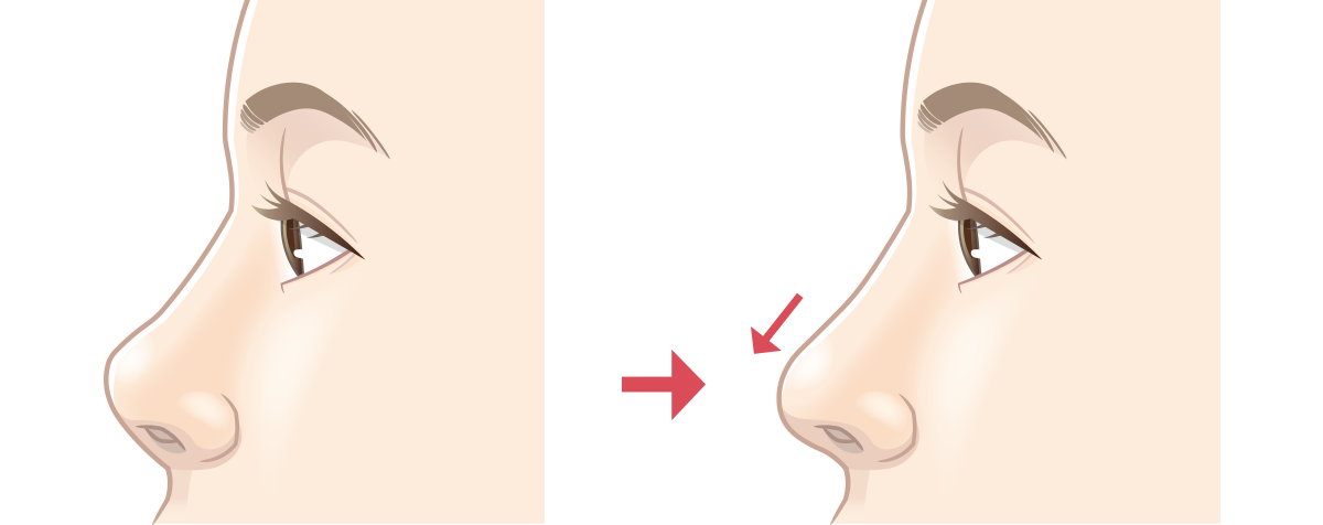 鼻中隔延長術のビフォーアフター