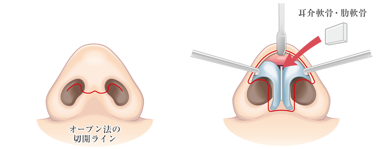 鼻中隔延長術のビフォーアフター