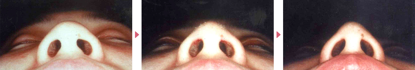 鼻尖形成症例写真