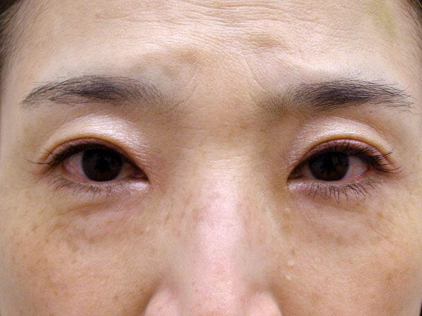 No127 50歳切らない眼瞼下垂 術後4日(メイクあり)の症例写真