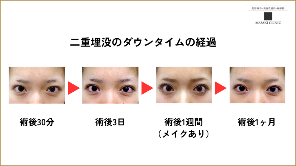 二重埋没のダウンタイムの経過