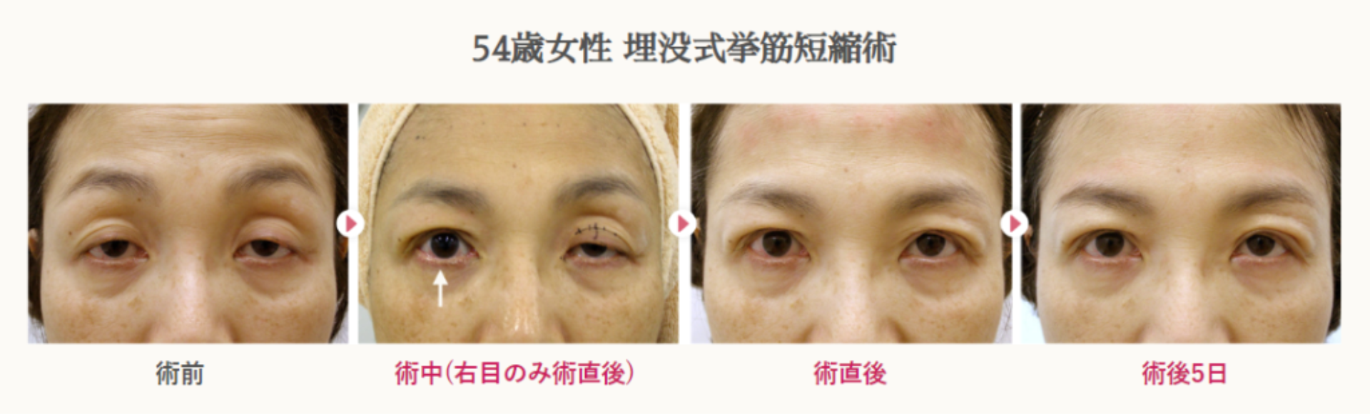 54歳女性の切らない眼瞼下垂による経過写真