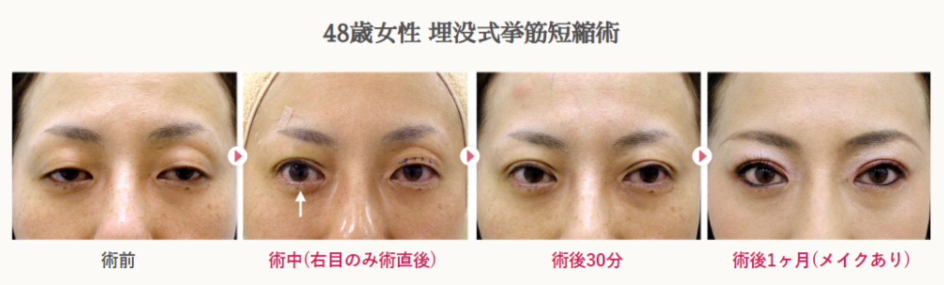 48歳女性の切らない眼瞼下垂による経過写真